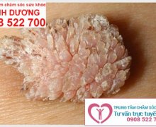 Cách điều trị bệnh sùi mào gà ở nam và nữ hiệu quả nhất