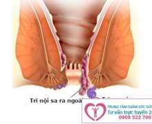 Dấu hiệu nhận biết bệnh sa búi trĩ chính xác nhất