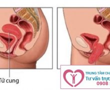Những nguyên nhân gây sa tử cung ở nữ giới