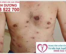 Săng giang mai có gây ngứa không?