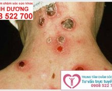 Săng giang mai là gì?