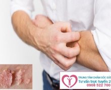 Sùi mào gà có ngứa không?