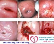Bệnh viêm cổ tử cung là gì ? Dấu hiệu nhận biết.