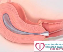 Tìm hiểu về phương pháp siêu âm âm đạo