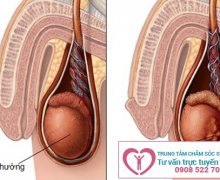 Triệu chứng của viêm tuyến tiền liệt