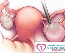 Tử cung bị ứ dịch là bị gì? có nguy hiểm không?