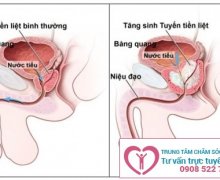 Phương pháp nào điều trị phì đại tuyến tiền liệt hiệu quả?