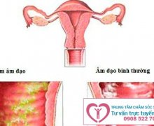 Bệnh phụ khoa và những tác hại không ngờ đến