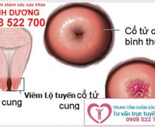 Viêm lộ tuyến cổ tử cung có nguy hiểm không?