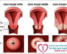 Mụn ở tử cung có phải bị viêm lộ tuyến hay không?
