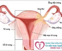 Một Số Kiến Thức Về Viêm Nội Mạc Tử Cung Bạn Cần Biết