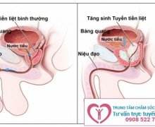 Các Phương Pháp Hỗ Trợ Điều Trị Viêm Tuyến Tiền Liệt Hiệu Quả Hiện Nay