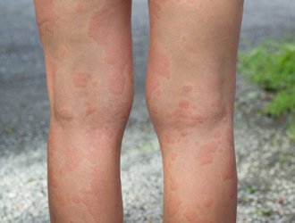 Thuốc trị mề đay bằng vảy của tê tê có được không?