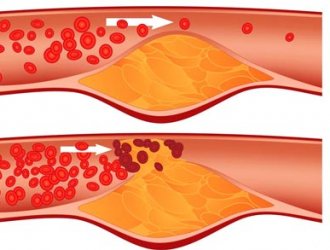 Cholesterol tăng cao nguy hiểm như thế nào